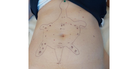 Abdominale Akupunktur 